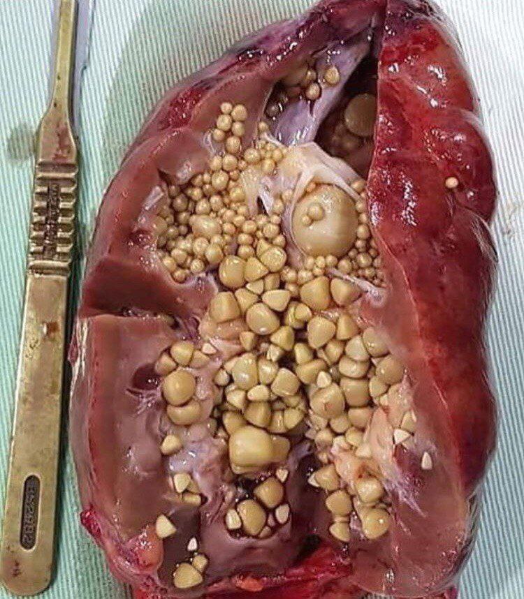 Diese Niere musste entfernt werden da der Versuch die Nierensteine zu entfernen nicht gelang