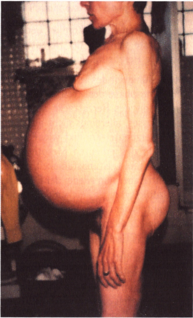 348 Bild Frau mit Aszites bzw Wasserbauch - Heilungsphase nach Bauchfell-Mesotheliom