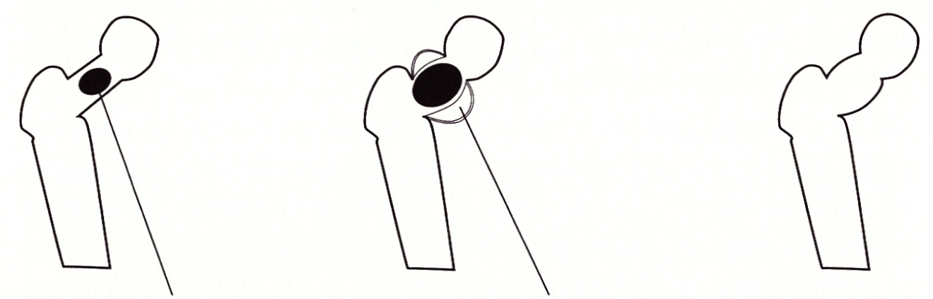 497 Knochen-Osteolyse - Pcl-Phase Leukaemie mit Schwellung - Ende Leukaemie Knochen bleibt dicker fester als zuvor